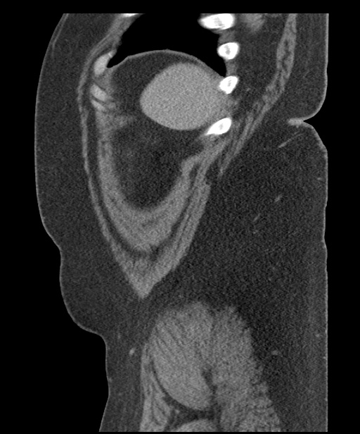 Acute mesenteric venous ischemia (Radiopaedia 46041-50383 Sagittal C+ portal venous phase 108).jpg