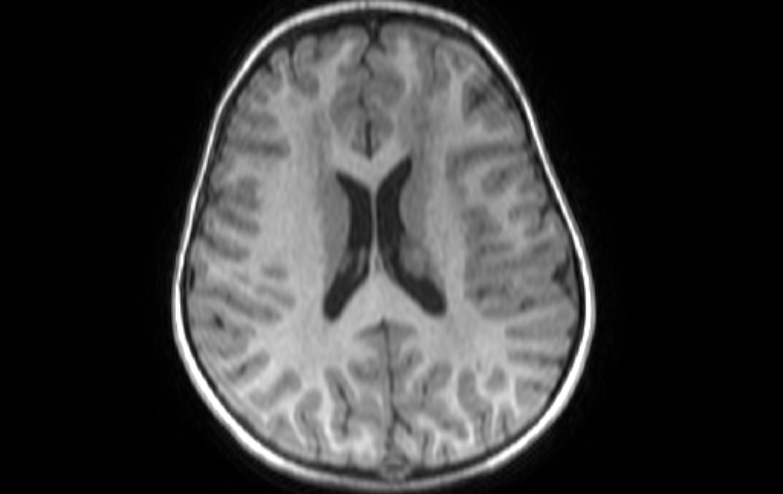 File:Acute necrotizing encephalitis of childhood (Radiopaedia 67356-76737 Axial T1 35).jpg