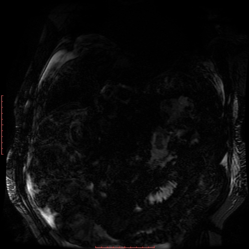Acute necrotizing pancreatitis (Radiopaedia 28194-28448 Coronal MRCP 60).jpg