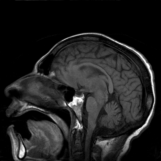 File:Acute necrotizing toxoplasma encephalitis (Radiopaedia 10683-11149 Sagittal T1 fat sat 10).jpg