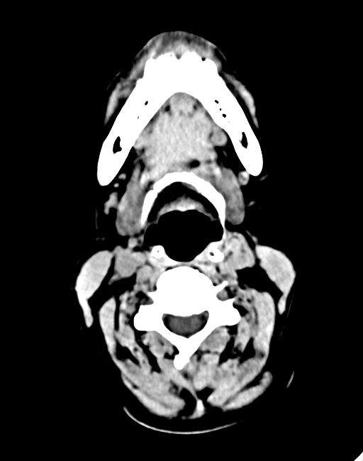 Acute on chronic subdural hematoma (Radiopaedia 74814-85823 Axial non-contrast 7).jpg