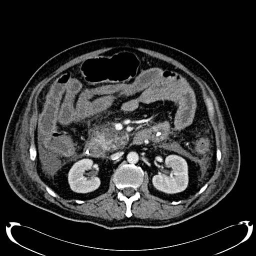 Acute pancreatic necrosis (Radiopaedia 13560-18500 Axial C+ portal venous phase 68).jpg