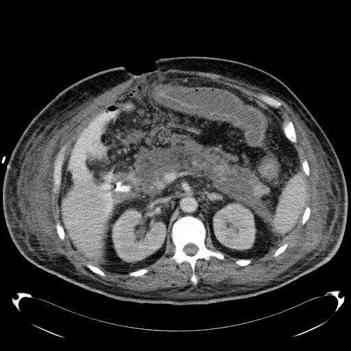 Acute pancreatic necrosis (Radiopaedia 13560-18503 Axial C+ portal venous phase 28).jpg
