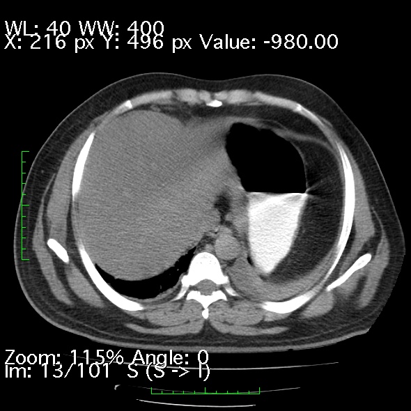 Acute pancreatitis (Radiopaedia 34043-35276 Axial non-contrast 13).jpg