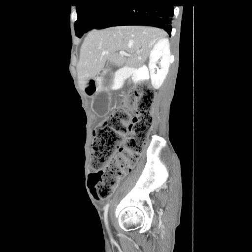 File:Acute pancreatitis (Radiopaedia 50213-55558 Sagittal C+ portal venous phase 1).jpg