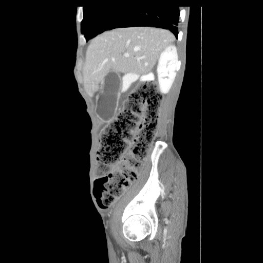 File:Acute pancreatitis (Radiopaedia 50213-55558 Sagittal C+ portal venous phase 8).jpg