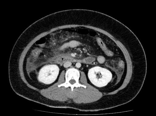 File:Acute pancreatitis (Radiopaedia 69236-79012 Axial C+ portal venous phase 44).jpg