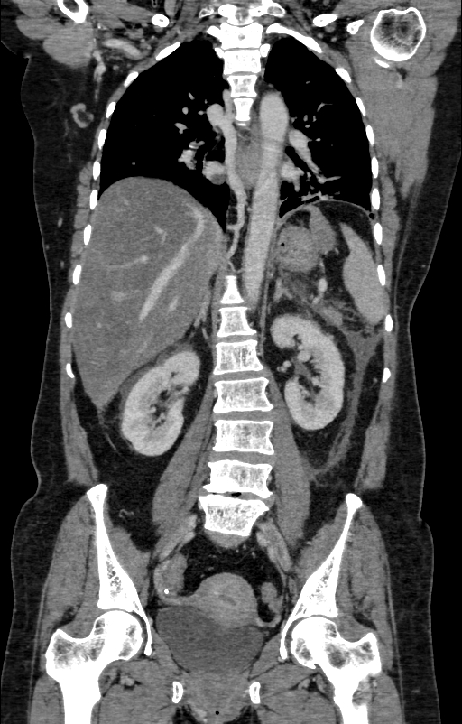 Acute pancreatitis (Radiopaedia 80007-93285 Coronal C+ portal venous phase 89).jpg