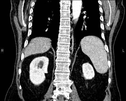Acute pancreatitis (Radiopaedia 85146-100701 Coronal C+ portal venous phase 57).jpg