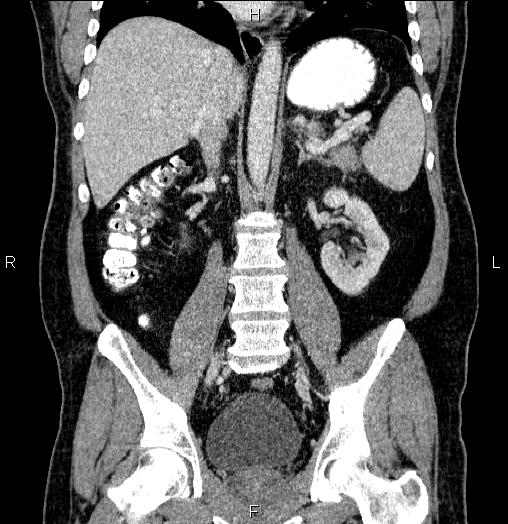 Acute pancreatitis (Radiopaedia 85390-101010 Coronal C+ portal venous phase 43).jpg