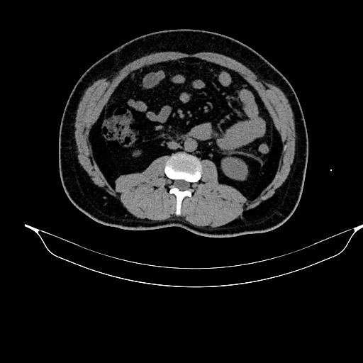 File:Acute pancreatitis (Radiopaedia 87428-103757 Axial non-contrast 50).jpg