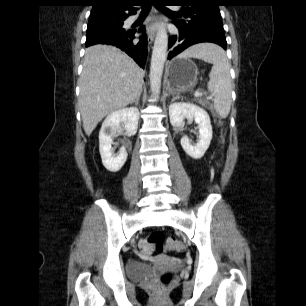 Acute pancreatitis - Balthazar C (Radiopaedia 26569-26714 Coronal C+ portal venous phase 44).jpg