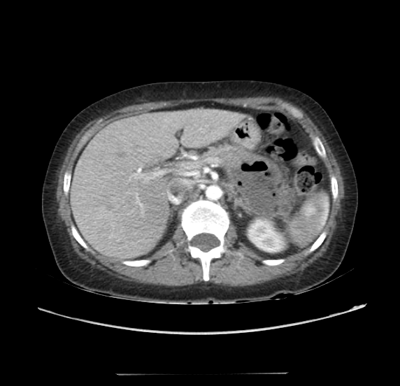 File:Acute pancreatitis - Balthazar E - post ERCP (Radiopaedia 27562-27772 Axial C+ arterial phase 16).png