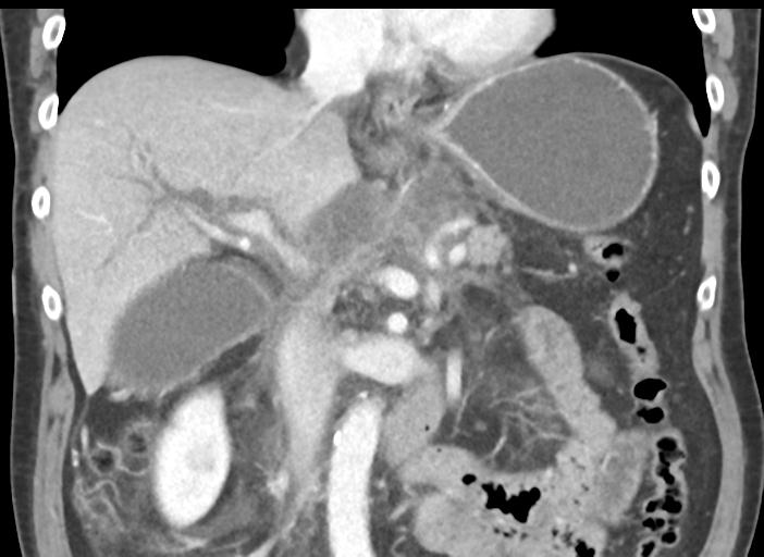 Acute pancreatitis and walled-off necrosis (Radiopaedia 29888-30404 Coronal C+ portal venous phase 27).jpg
