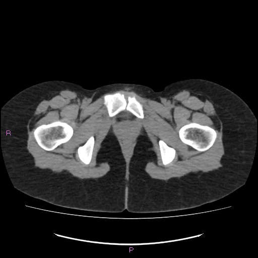 File:Acute pancreatitis secondary to stone at minor papilla and pancreatic divisum (Radiopaedia 76570-88333 Axial non-contrast 82).jpg