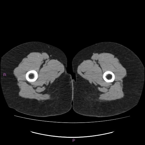 Acute pancreatitis secondary to stone at minor papilla and pancreatic divisum (Radiopaedia 76570-88333 Axial non-contrast 93).jpg