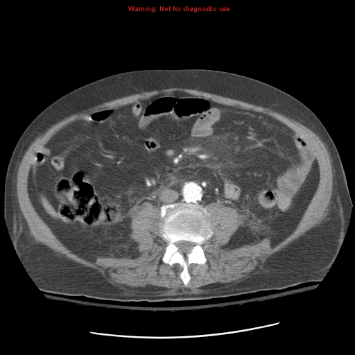 Acute pancreatitis with incidental pancreatic lipoma (Radiopaedia 10190-10730 Axial C+ arterial phase 63).jpg