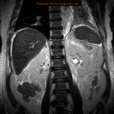 File:Acute pancreatitis with incidental pancreatic lipoma (Radiopaedia 10190-10732 Coronal T2 22).jpg