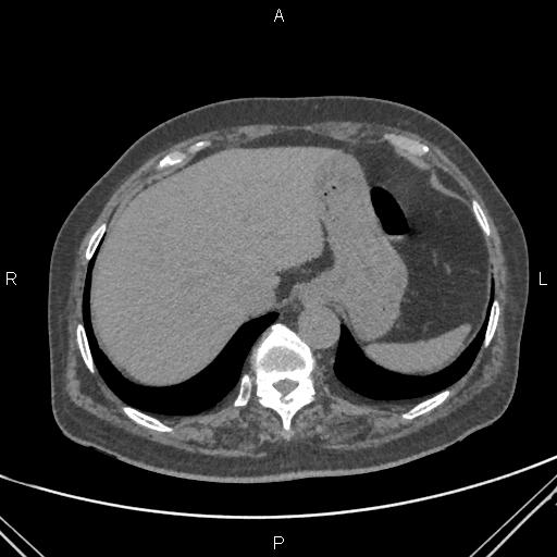 Acute renal artery occlusion (Radiopaedia 86586-102682 Axial non-contrast 9).jpg