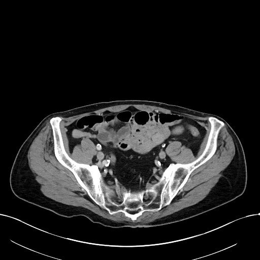 Acute renal infarction (Radiopaedia 59375-66736 Axial C+ portal venous phase 90).jpg