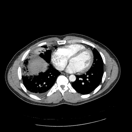 Acute segmental pulmonary emboli and pulmonary infarction (Radiopaedia 62264-70444 Axial C+ CTPA 76).jpg