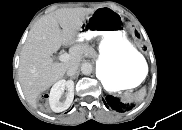 Acute small bowel (ileal) volvulus (Radiopaedia 71740-82139 Axial C+ portal venous phase 63).jpg