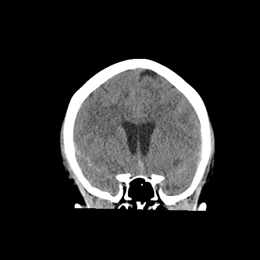 Acute subarachnoid hemorrhage and accessory anterior cerebral artery (Radiopaedia 69231-79008 Coronal non-contrast 30).jpg