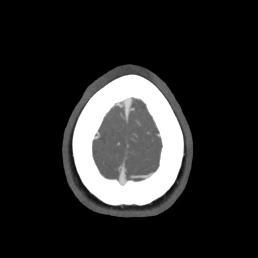Acute subarachnoid hemorrhage and accessory anterior cerebral artery (Radiopaedia 69231-79009 D 65).jpg