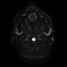 Acute superior cerebellar artery territory infarct (Radiopaedia 84104-99358 Axial DWI 64).jpg