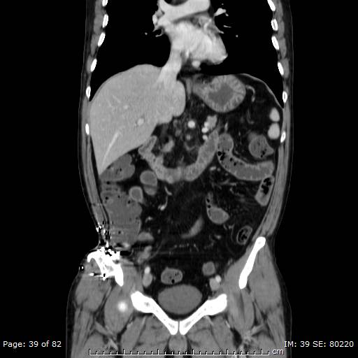 Acute superior mesenteric artery occlusion (Radiopaedia 43636-47060 Coronal C+ portal venous phase 24).jpg