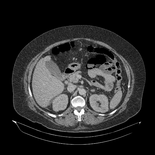File:Acute superior mesenteric artery occlusion (Radiopaedia 51288-56960 Axial C+ portal venous phase 35).jpg