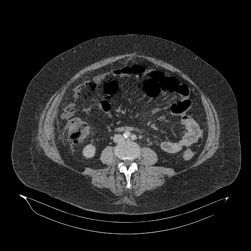 Acute superior mesenteric artery occlusion (Radiopaedia 51288-56960 Axial C+ portal venous phase 57).jpg