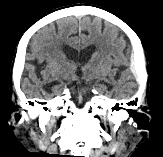 File:Acute traumatic subdural hematoma (Radiopaedia 82921-97257 Coronal non-contrast 47).jpg
