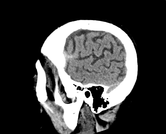 File:Acute traumatic subdural hematoma (Radiopaedia 82921-97257 Sagittal non-contrast 17).jpg