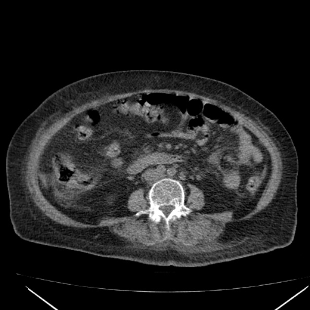 Acute tubular necrosis (Radiopaedia 28077-28334 Axial non-contrast 39).jpg