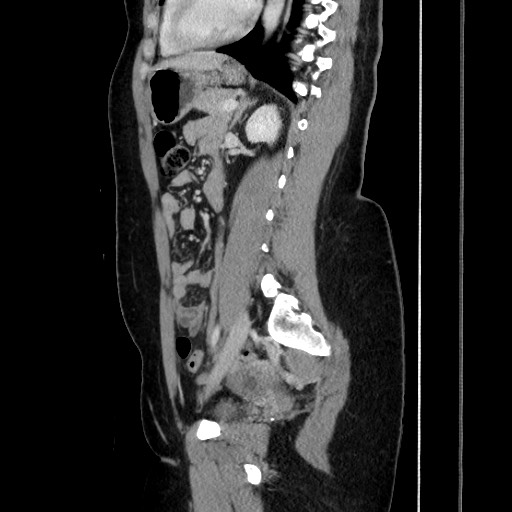File:Acute uncomplicated appendicitis (Radiopaedia 73704-84499 Sagittal C+ portal venous phase 130).jpg