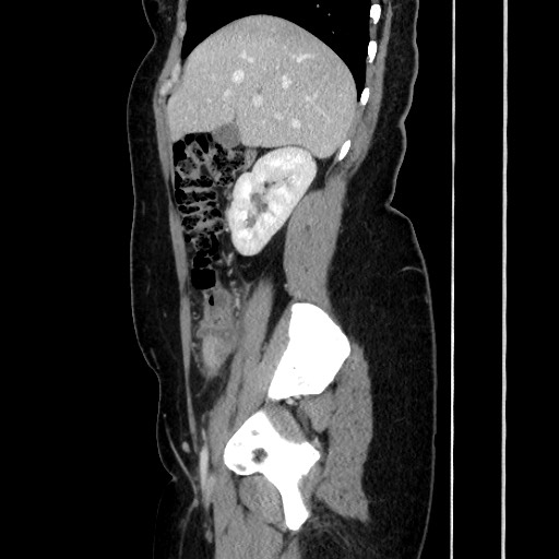 Acute uncomplicated appendicitis (Radiopaedia 73704-84499 Sagittal C+ portal venous phase 80).jpg
