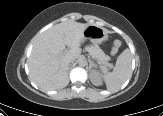 Acute unilateral nonhemorrhagic adrenal infarction (Radiopaedia 67560-76957 Axial non-contrast 21).jpg