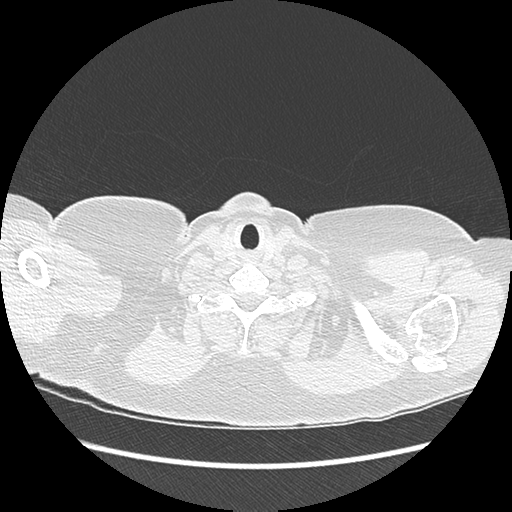 Adenocarcinoma in situ of lung (Radiopaedia 38685-40829 B 3).png