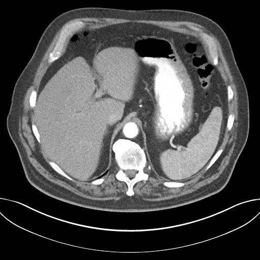 File:Adenocarcioma of rectum- T1 lesion (Radiopaedia 36921-38547 Axial C+ arterial phase 52).png
