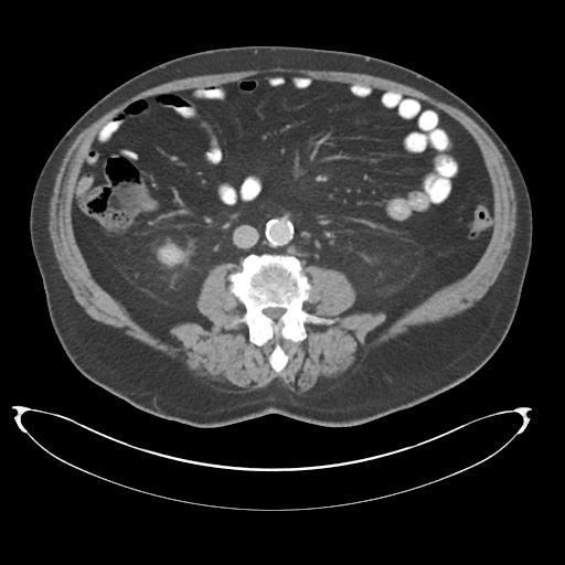 Adenocarcioma of rectum- T1 lesion (Radiopaedia 36921-38547 Axial C+ portal venous phase 47).png