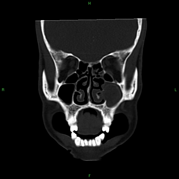 File:Adenoid cystic carcinoma of hard palate (Radiopaedia 26137-26273 Coronal bone window 8).jpg