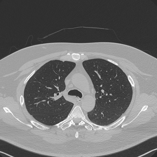 Adenoid cystic carcinoma of the trachea (Radiopaedia 49042-54137 Axial lung window 111).jpg