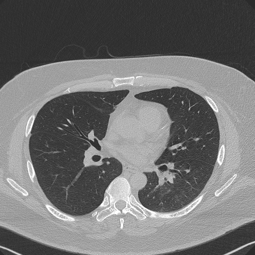 Adenoid cystic carcinoma of the trachea (Radiopaedia 49042-54137 Axial lung window 184).jpg
