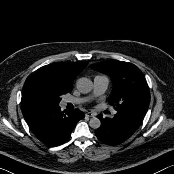Adenoid cystic carcinoma of the trachea (Radiopaedia 49042-54137 Axial non-contrast 169).jpg