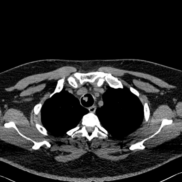 Adenoid cystic carcinoma of the trachea (Radiopaedia 49042-54137 Axial non-contrast 57).jpg