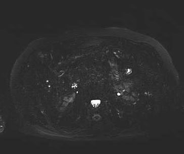 File:Adenomyomatosis of the gallbladder (Radiopaedia 50246-55587 Axial 9).png