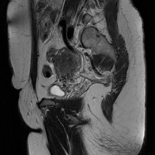 File:Adenomyosis-scar endometriosis (Radiopaedia 65863-75022 Sagittal T2 20).jpg