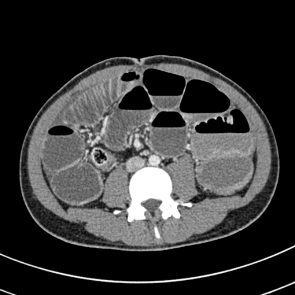 File:Adhesional small bowel obstruction (Radiopaedia 52107-57980 Axial C+ portal venous phase 70).jpg