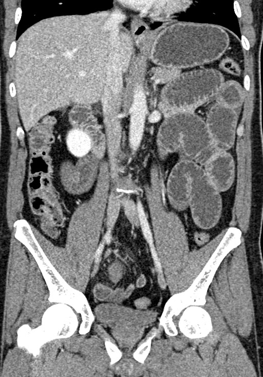Adhesional small bowel obstruction (Radiopaedia 58900-66131 Coronal C+ portal venous phase 145).jpg